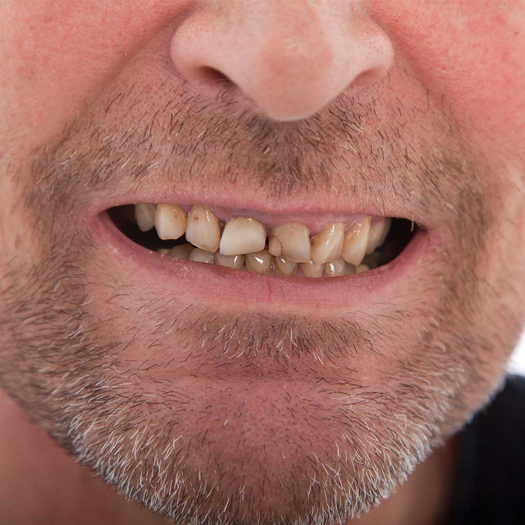 Broken-Teeth-Treatment-in-Doncaster-East