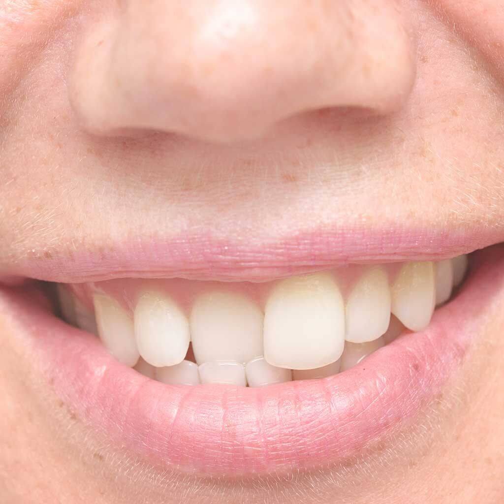 Crooked-and-Misaligned-Teeth-Treatment-in-Doncaster-East