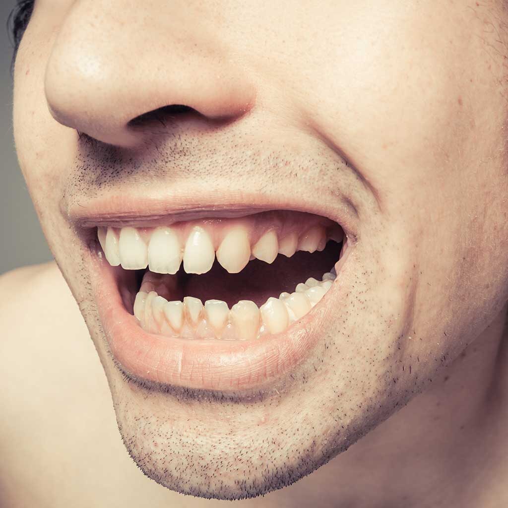 Gum-Disease-Treatment-in-Doncaster-East