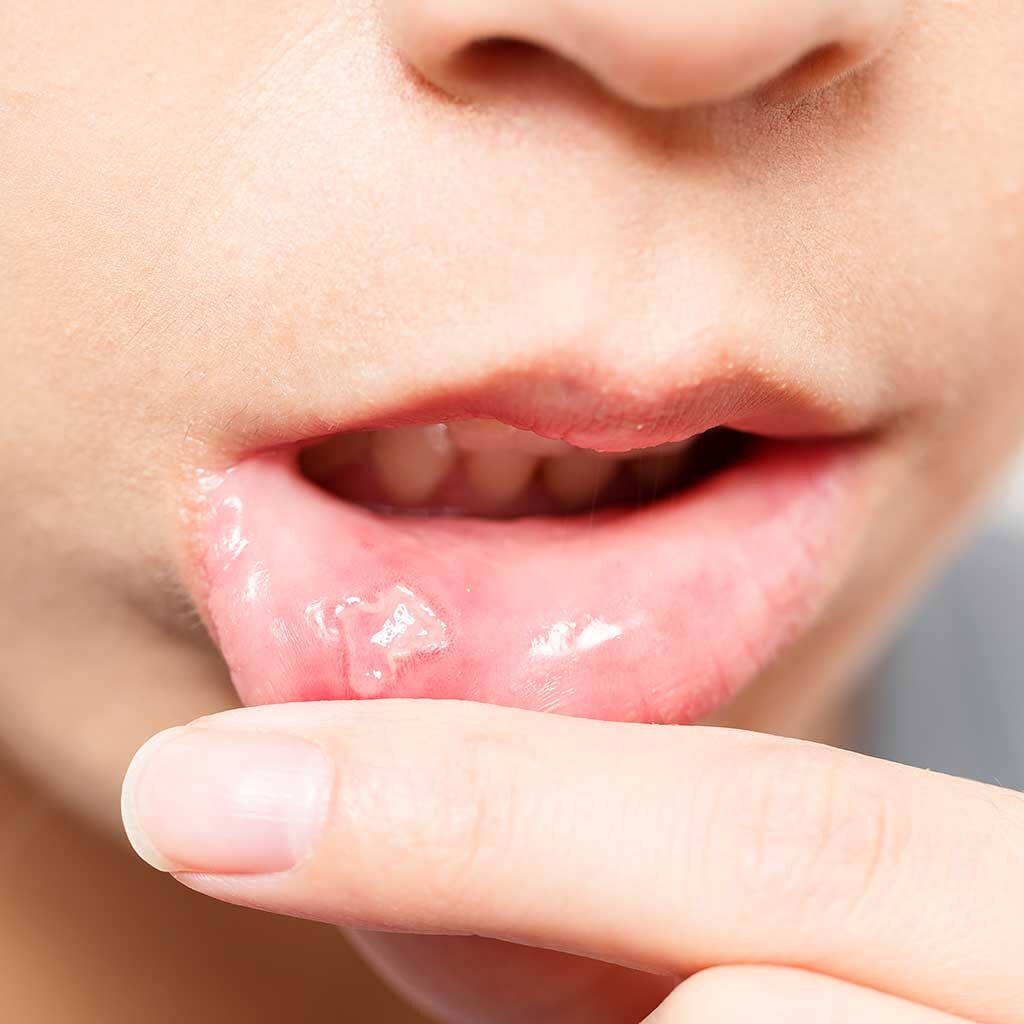 Mouth-Ulcers-Treatment-in-Doncaster-East