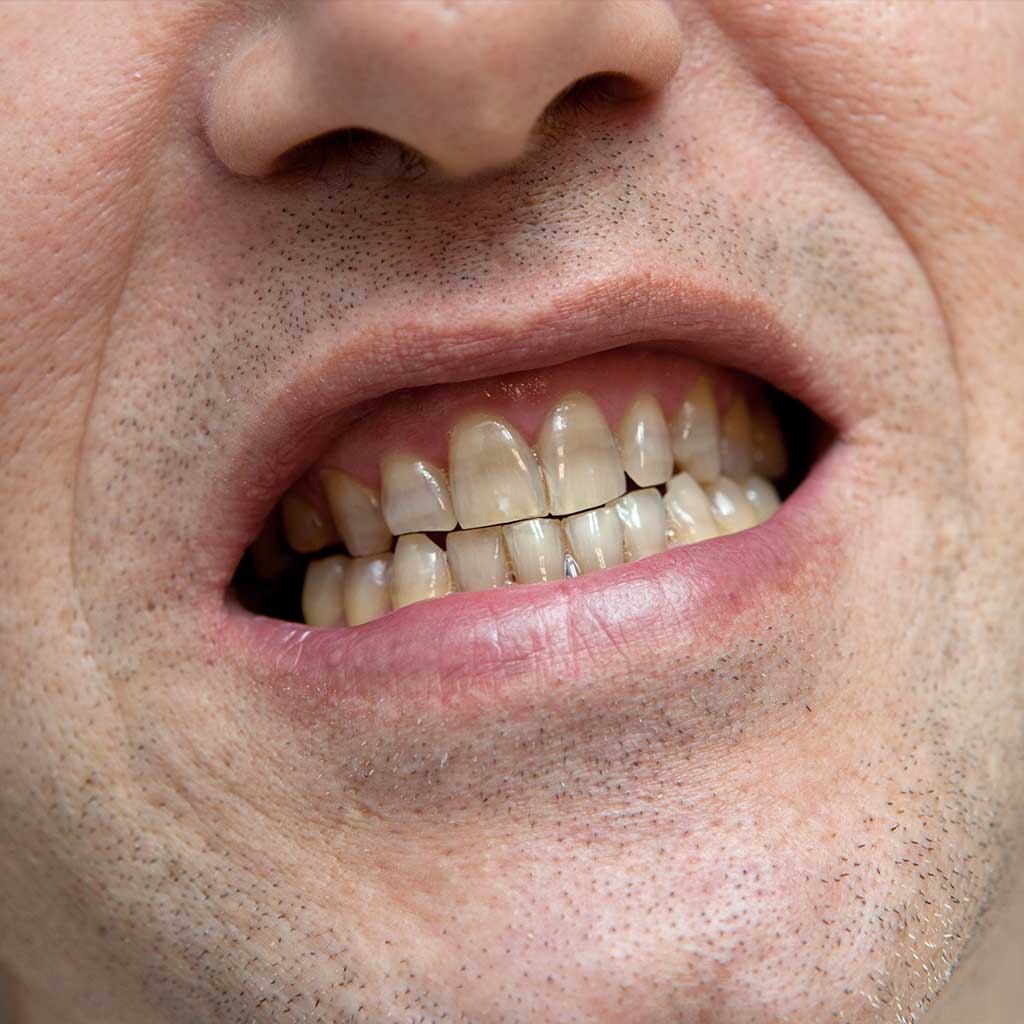 Stained-&-Discoloured-Teeth-Treatment-in-Doncaster-East